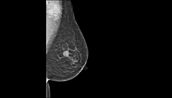 Mammogram xray