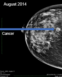 Mammogram xray